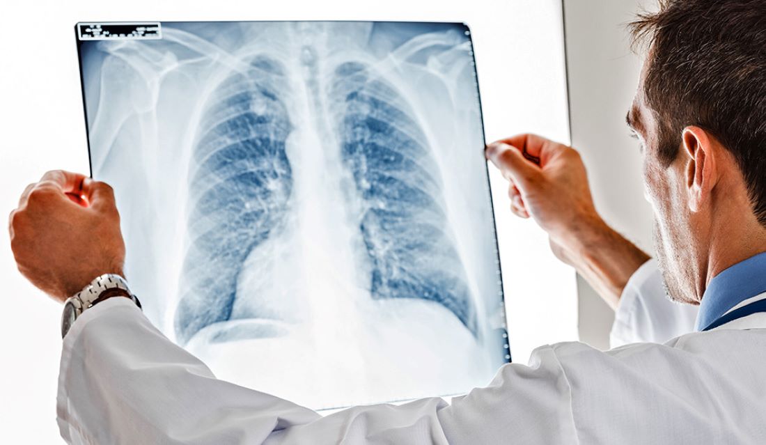 Μελέτη NHS: Πρόβλεψη υποτροπής καρκίνου του πνεύμονα μετά από ακτινοθεραπεία