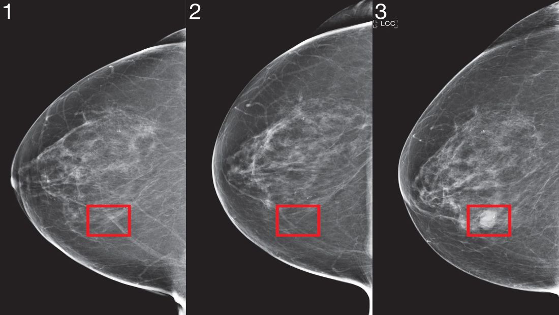 Ερευνητές ανακάλυψαν πώς μπορούν να «φρενάρουν» τις μεταστάσεις στον καρκίνο του μαστού